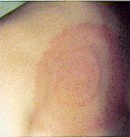 erythema migrans rash ("migrating redness"), as seen in North American Lyme borreliosis
